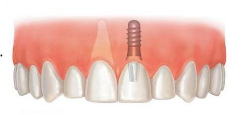 国产种植牙流程视频,从术前评估到术后护理