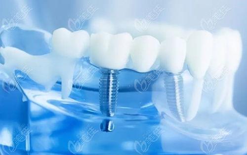 国产种植牙流程视频,从术前评估到术后护理