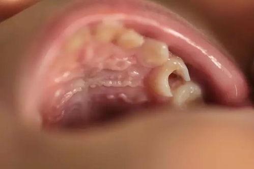 补国产牙容易掉吗视频,掉落风险解析与预防措施  第2张